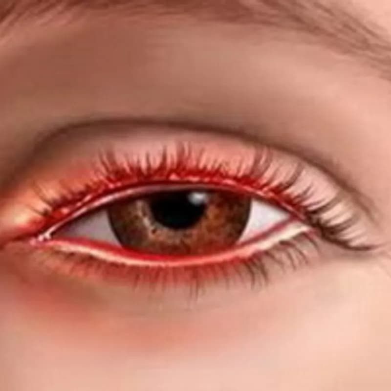 Blefarit nədir? Əlamətləri, səbəbləri və müalicəsi